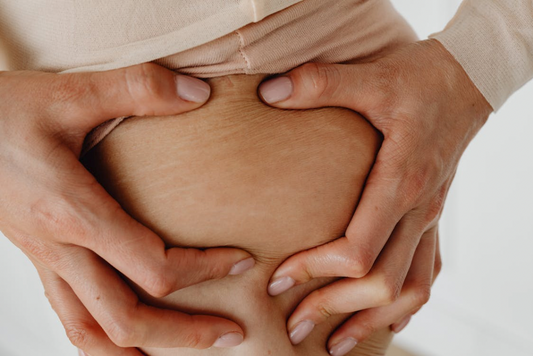 How To Prevent Stretch Marks: Easier Than You Might Think